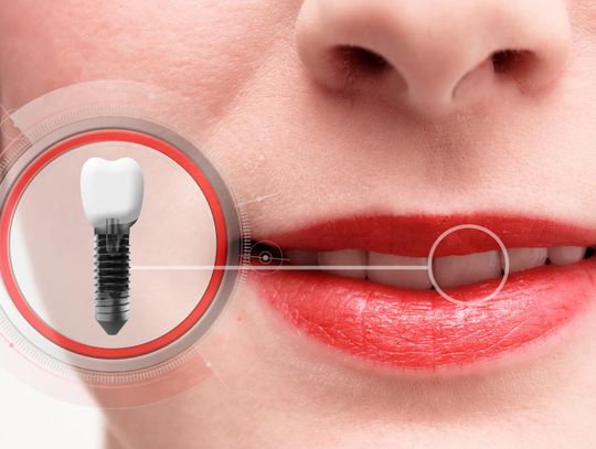 Implanty zębów – zdrowie i estetyka